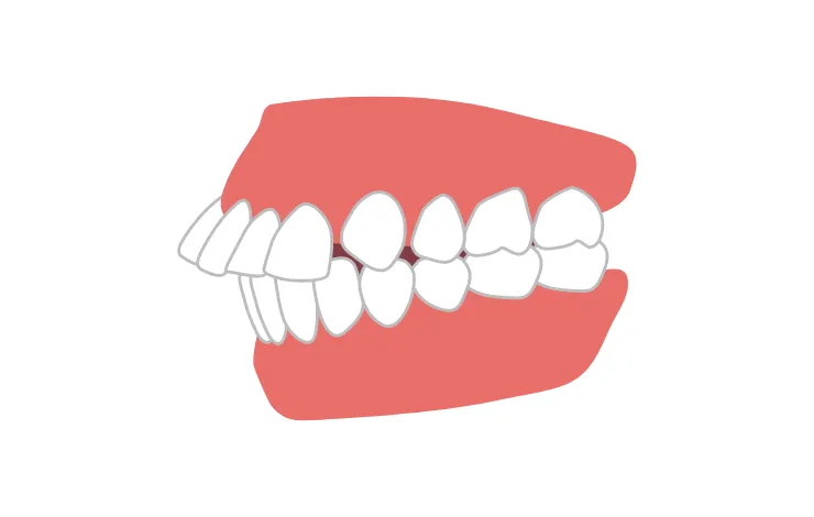 出っ歯 (上顎前突)