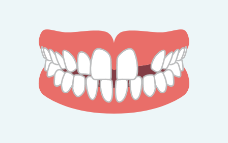 先天性欠損歯（歯が足りない）